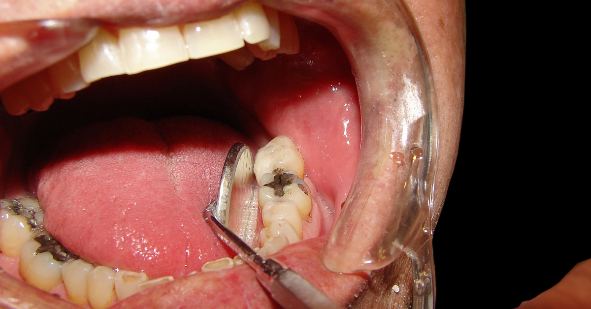 Tonsil Removal May Be Problematic in Grown-Ups | RxWiki