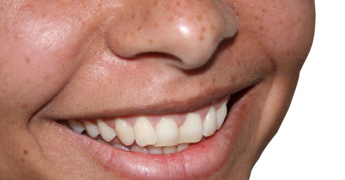 Dental Problems Plague Crohn’s Patients RxWiki