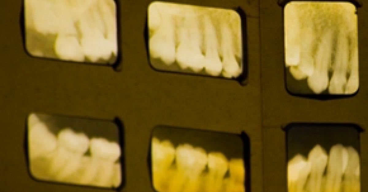 Dental Xrays Increase Brain Cancer Risks RxWiki