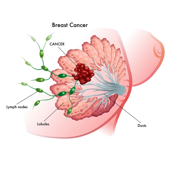 All About Breast Cancer: Breast cancer: defined